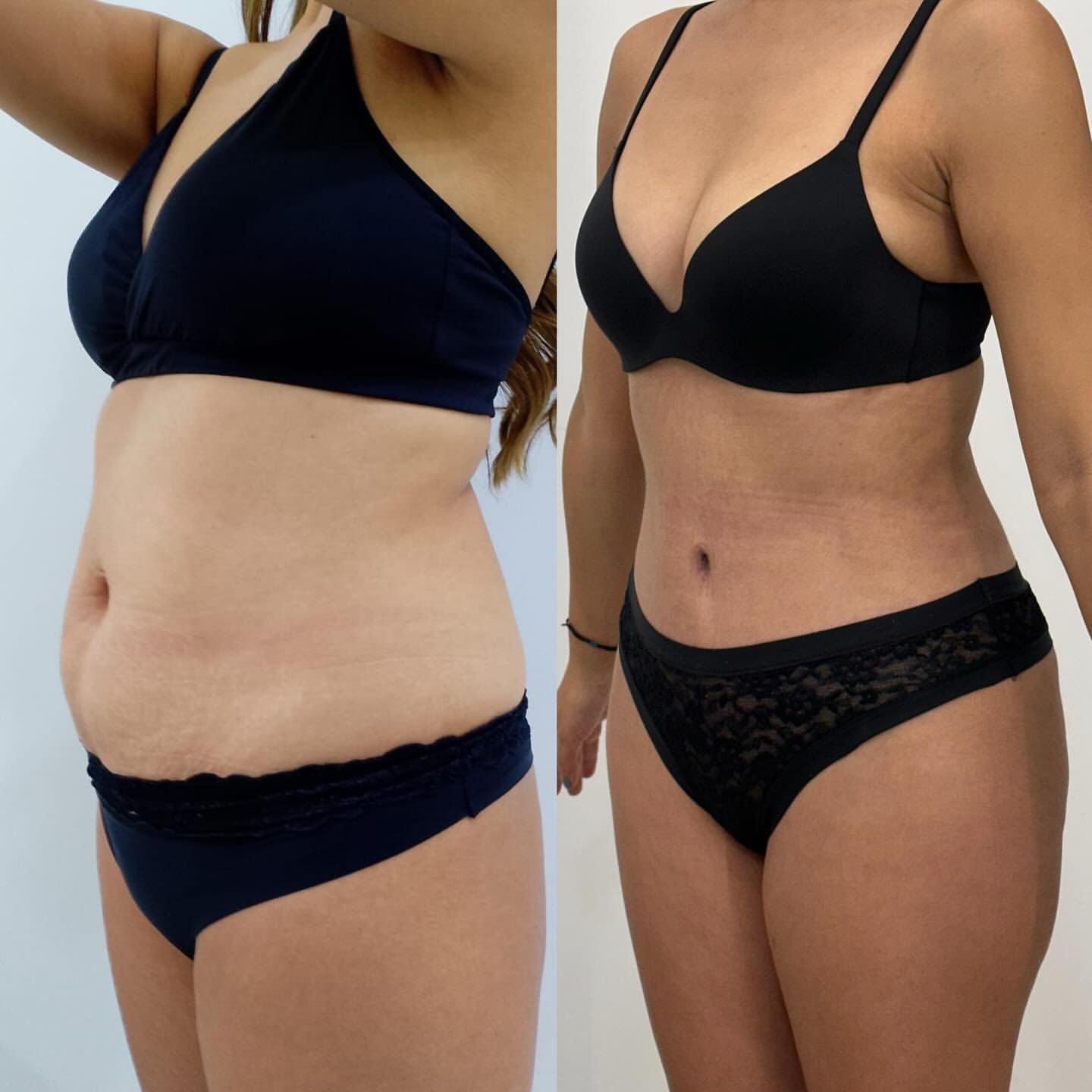 Resultado antes y después — Dr. Alejandro Orozco