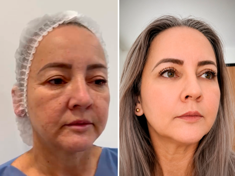 Blefaroplastia, antes y después — Dr. Alejandro Orozco