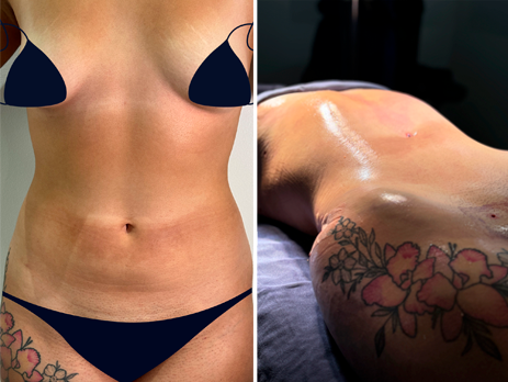 Liposucción, antes y después — Dr. Alejandro Orozco