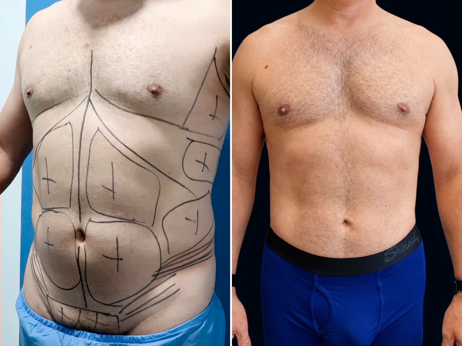 Lipo masculina, antes y después — Dr. Alejandro Orozco